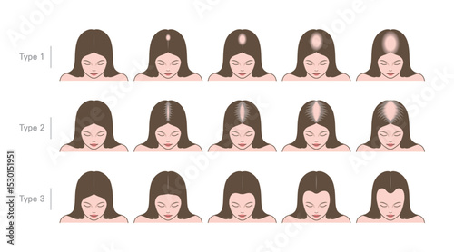 Stages of baldness of women. Female character head top view with hair loss process. Aging problems, types of alopecia.