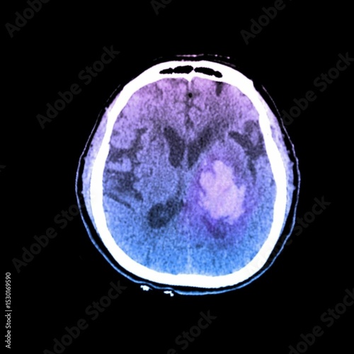 head ct scan of bleeding stroke on left basal ganglia	
