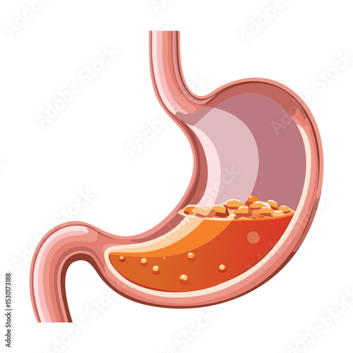 Stomach with Partially Digested Solid Food
