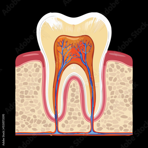 Early Tooth Decay Showing Internal Damage