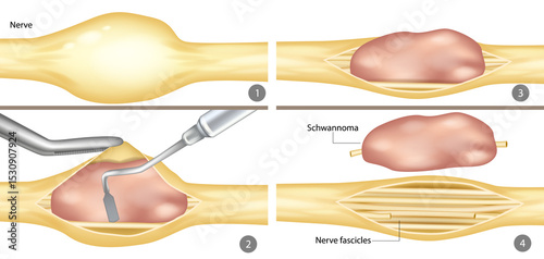 Surgical Removal of Schwannoma from Peripheral Nerve. Step-by-Step Illustration of Schwannoma Excision. Medical Diagram of Nerve Tumor Resection