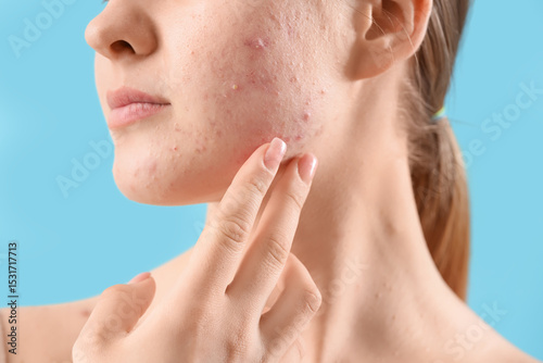 Teenage girl with acne prob...