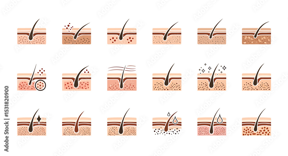 Fototapeta premium Vector Icons Set of Illustrated hair follicle health stages from healthy to damaged with skin layers. Vector Illustrations