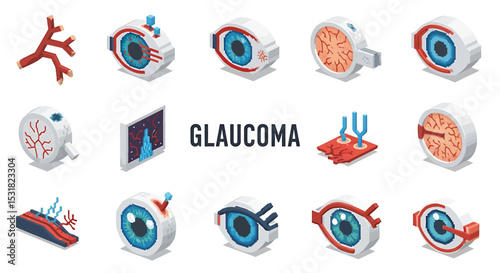 Vector Icons Set of Isometric Glaucoma Disease Progression with Eye Anatomy and Blood Vessel Damage. Vector Illustrations