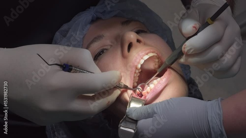 Dental team performs surgical procedure on woman wisdom tooth extraction. Doctors use mouth prop to keep jaw open ensuring clear access to teeth