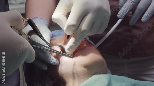 Professional dentists in gloves use special thread to sew up wound during dental procedure. Part of preparation for implant placement in modern clinic