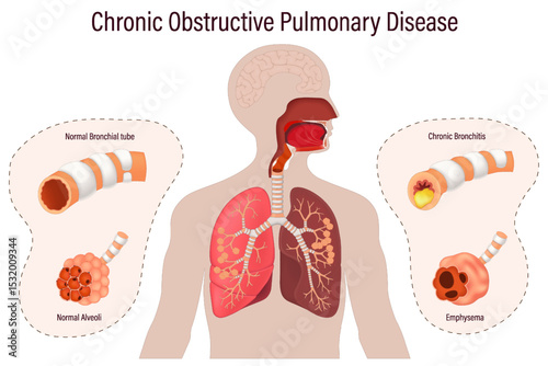 Chronic obstructive pulmonary disease (COPD). Comparison between normal bronchus and alveoli with bronchitis and emphysema. Human respiratory system.