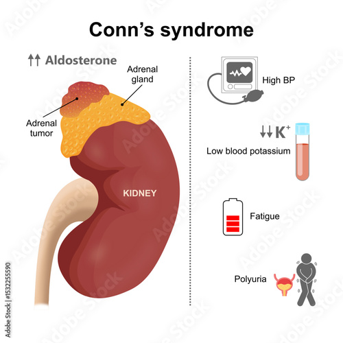 Conn's syndrome kidney adrenal gland Illustration