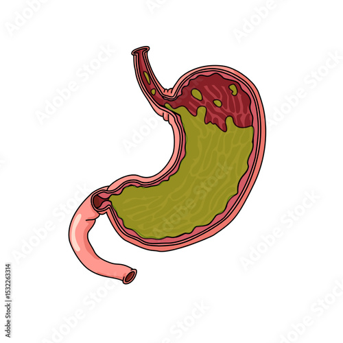 Vector illustration stomach disease Gastroesophageal Reflux Disease. GERD stomach. Illustration for medical, poster symbol, logo, or study science