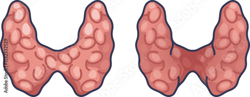 Illustration of thyroid gland showing normal and diseased states.