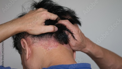 Konstfotografi A man who is stressed by psoriasis