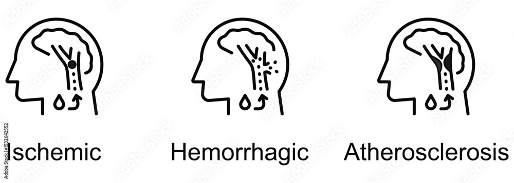 Fototapeta premium Stroke Types banner web icon vector illustration of Ischemic, Hemorrhagic, Atherosclerosis