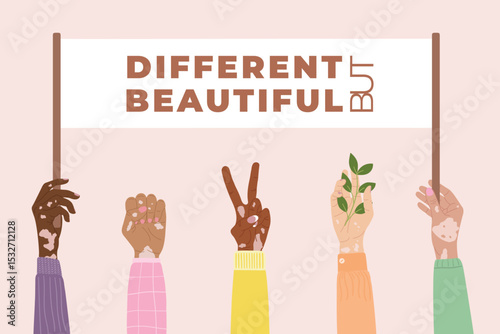 Different but beautiful concept. Diversity hands with vitiligo skin disease stacking together. Body positive concept. Hand drawn vector illustration