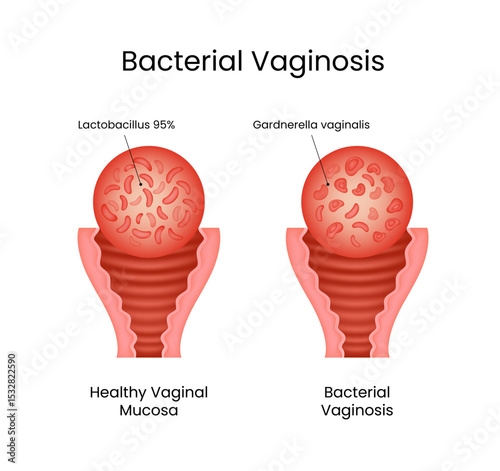 Bacterial Vaginosis Healthy vs Infected Vagina