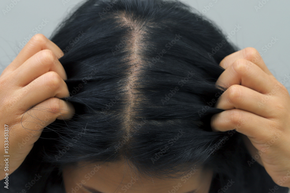 Fototapeta premium Woman with hair loss dryness and frizziness