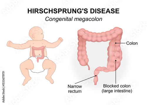 Hirschsprung's disease, Congenital megacolon Illustration