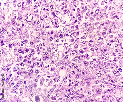 Tableau sur toile Photomicrographic image showing Metastatic squamous cell carcinoma of a lymph node, a type of skin cancer