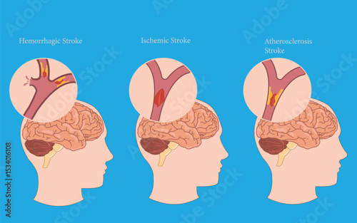 Medical illustration showing hemorrhagic, ischemic, and atherosclerosis stroke types in the brain.