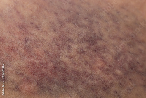 A person's leg has a bruise on it