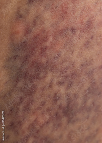 A person's leg has a bruise on it