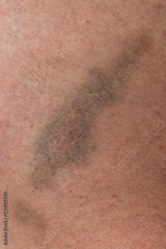A bruise on a person's arm