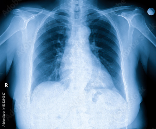 X-Ray Image Of Human Chest for a medical diagnosis