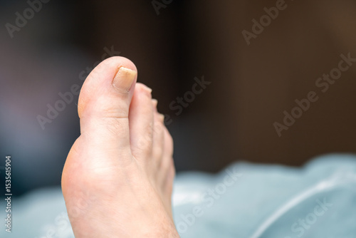 Healing toenail on a big toe recovering from fungal infection, showing signs of healthy regrowth