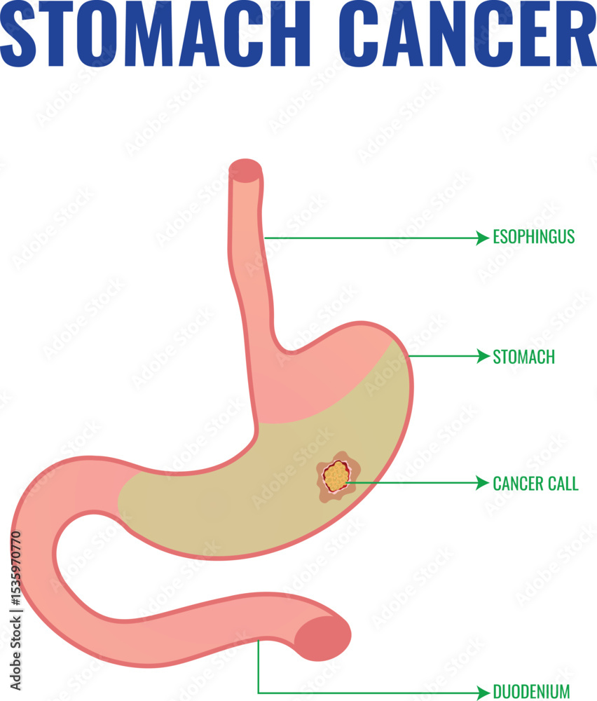 Fototapeta premium Stomach Cancer Overview Risk Factors and Management