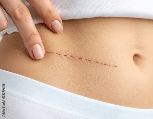 Understanding and Healing Abdominal Scars A Guide to Recovery and Scar Treatment
