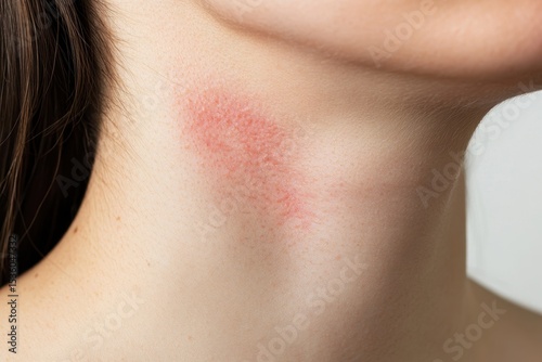 Wallpaper Mural Skin Redness and Irritation on Neck Area of a Young Woman Torontodigital.ca