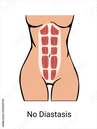 No Diastasis in a woman before and after pregnancy. The anatomy of a Woman. Woman muscular corset, body part. Vector illustration
