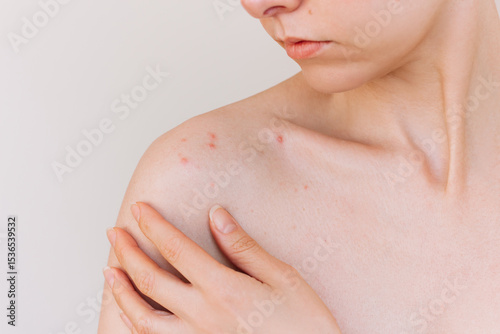 Young caucasian woman suffering acne and skin rash on her shoulder. Skin diseases. Hormonal disorders.