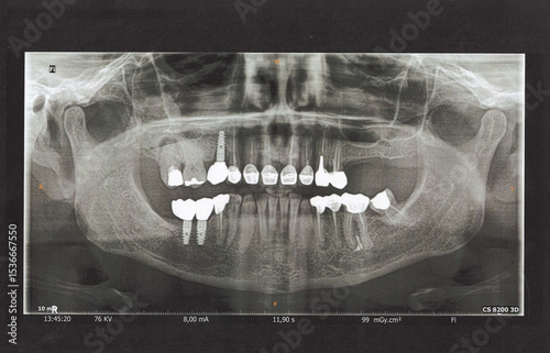 radio dentaire panoramique avec implants et couronnes