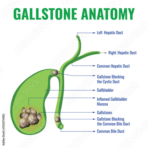 Gallstone Anatomy Illustration Showing Gallbladder and Bile Ducts with Stones