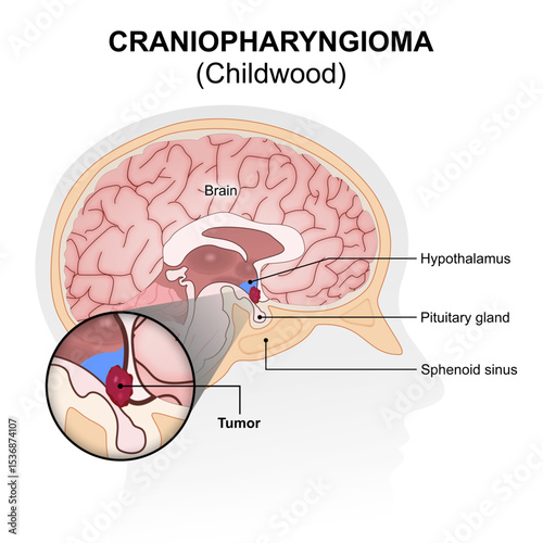 Childhood Craniopharyngioma