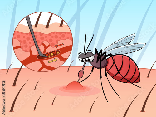 Mosquito drinks blood. Parasitic insect, cartoon character, sucking blood pest, skin surface with capillaries, scheme. Bloodsucker wound. Painful skin bite, malaria tidy vector concept