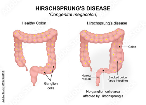 Hirschsprung's disease Congenital megacolon Illustration