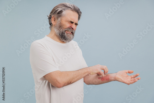 Senior man scratching itchy eczema on arm suffering from dermatitis
