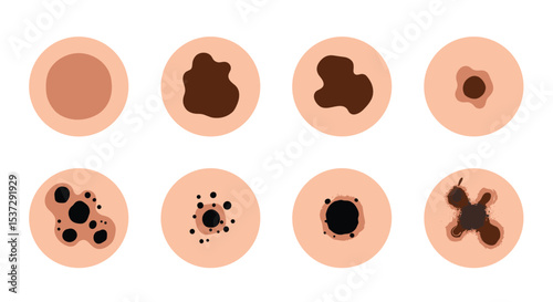 Skin Mole Analysis A Guide to Understanding Normal and Potentially Harmful Moles