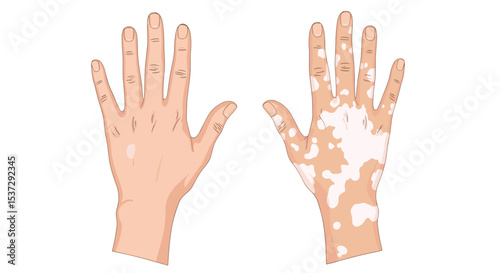Understanding Vitiligo A Comprehensive Guide to Causes Symptoms Diagnosis and Treatment Options Available