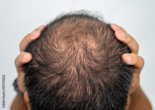A bald spot on men's head. Baldness is related to your genes and male sex hormones. It usually follows a pattern of receding hairline and hair thinning on the crown.