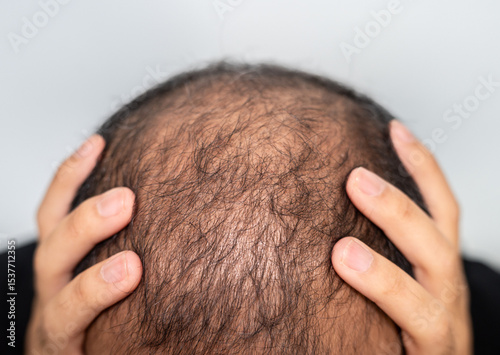 Asian man having stress cause of baldness problem. Baldness is related to your genes and male sex hormones.