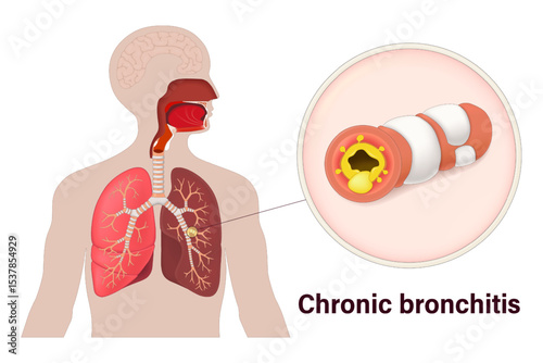 Chronic bronchitis. Lung diseases anatomy. Human respiratory system.