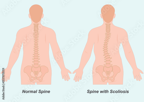 Scoliosis is a side to side curve of spine.