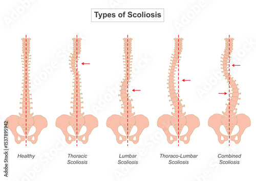 Scoliosis is a condition characterized by an abnormal curvature of the spine.