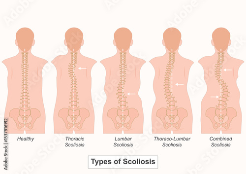 Scoliosis is a condition where the spine curves abnormally to the side.