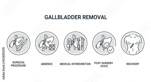 Gallbladder removal process depicted in five stages: surgery, absence, intervention, post-op, recovery.