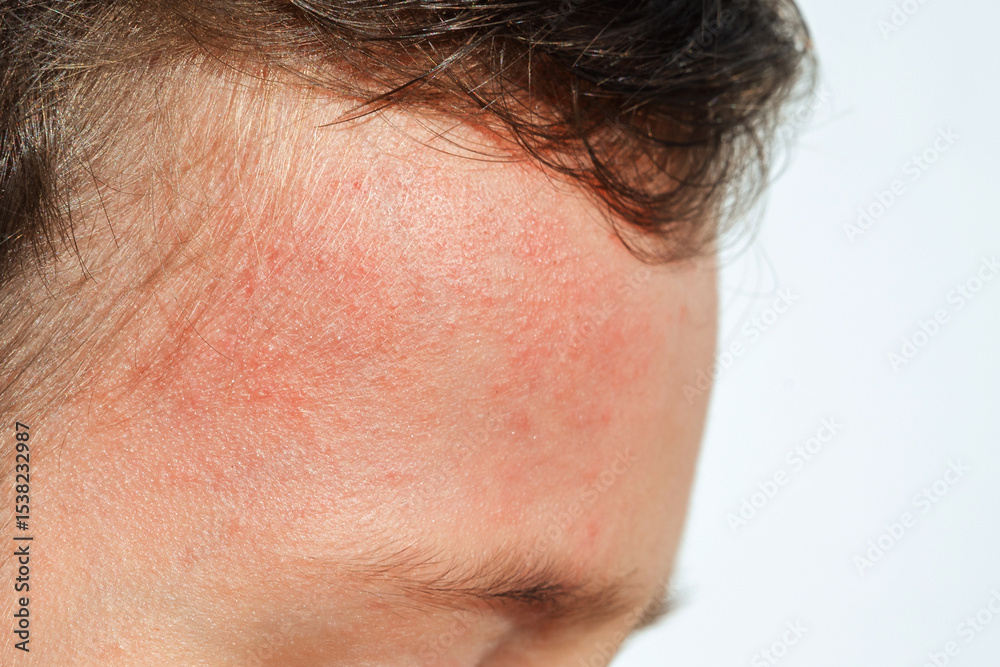 Obraz premium Red rashes from the Coxsackie virus on a child face on white background. Chickenpox symptoms on children's skin close-up