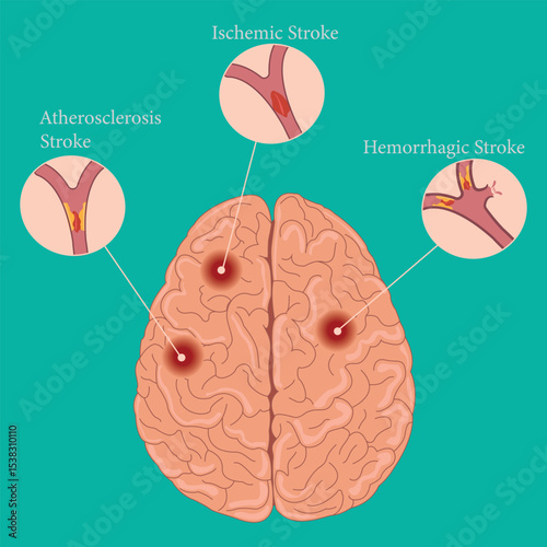 Medical diagram showing stroke types in the human brain with close-up views