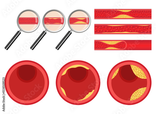 Illustration depicting blood vessel blockage with cholesterol plaque formation
